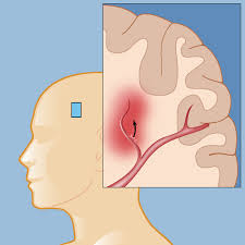 Neck or back pain 3. Intracerebral Hemorrhage Weill Cornell Brain And Spine Center
