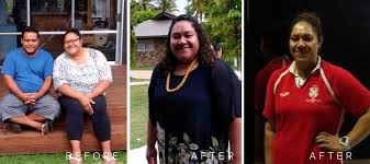 Gastric bypass or another form of weight loss surgery may help you. Before And After Surgery Archives Auckland Weight Loss Surgery
