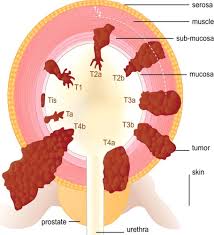 Pain or burning with urination. Urinary Bladder Cancer Role Of Mr Imaging Radiographics