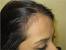 Female Hair Loss Back Of Head