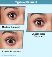 We did not find results for: Cataract Causes Symptoms Diagnosis Treatment Prevention