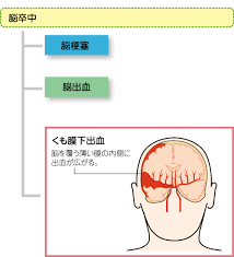 Contribute to ugvf2009/miles development by creating an account on github. ãã‚‚è†œä¸‹å‡ºè¡€ã®æ¦‚è¦ Myä»‹è­·ã®åºƒå ´