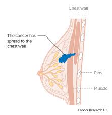 Pin On Breast Issues 2020