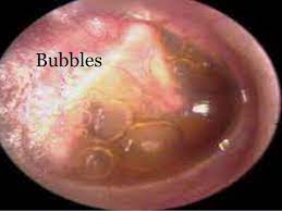 Acute otitis media (aom) is common in children but much less so in adults. Otitis Media With Effusion And Acute Suppurative Otitis Media Diagram Quizlet
