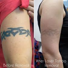 Tattoo removal cost is determined by many factors, while multiple sessions are necessary, size is the most important variable to determine how much tattoo removal will cost for you we will need to see your tattoo in person to give you an accurate cost. Laser Tattoo Removal Before And After Update 2021 Laser Tattoo Tattoo Removal Tattoo Removal Cost