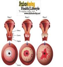 Everyone's discharge is different, so it's a case of knowing what is. 10 Early Signs Of Cervical Cancer You Should Not Ignore Health Nigeria
