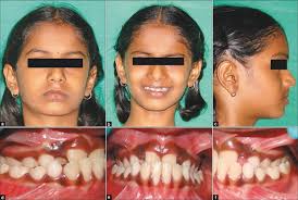 We did not find results for: How To Fix An Underbite Without Surgery Quora