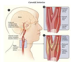 A tear in the lining of one of these vessels is called a cervical artery dissection. Carotid Artery Thickness
