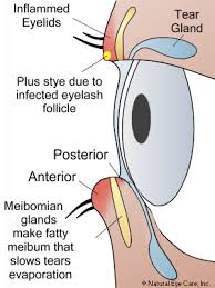 It also looks at the symptoms and causes of the condition. Blepharitis Information Symptoms Treatment Options