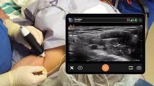 Image result for Axillary Nerve Block