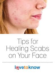 Healing Scabs On Your Face Lovetoknow Scab On Face Scab Healing Face Healing