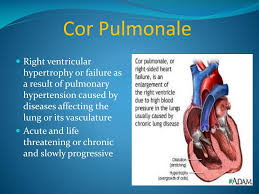Image result for Cor Pulmonale