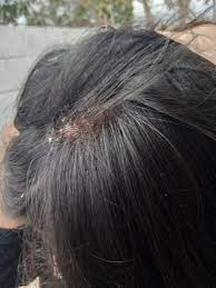 Check items to add to the cart or select all. Does Having The Hair Long Supports The Growing Of Dandruff Dandruff