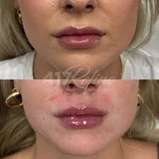 Lip filler diaries ✧ Before story- previous lip filler that had migrated  above top lip