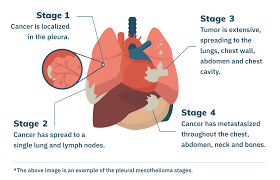 Mesothelioma help cancer organization, new york. 4 Mesothelioma Stages Staging Systems Treatment By Stage