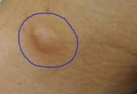 While some hard or pea sized lumps can be normal and mostly goes away on their own, others can lymph nodes are located in the head, neck armpit and groin region. Lump In Armpit Painful Small Hard Male Female Induced Info