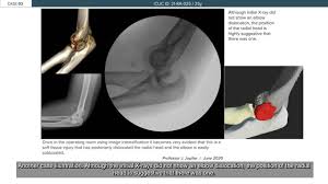 Image result for Radial Head Dislocation