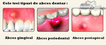 In abces apare o colectie cu puroi la nivelul gingiei corespunzatoare unui dinte. Gangrena PulparÄƒ