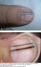 Image result for Acral lentiginous melanoma nail