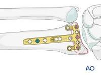 ORIF - Palmar plate for Partial articular fracture of the ...