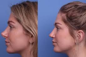 Rinoplastia en Banadero, Honduras