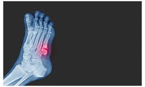 Image result for Metatarsal