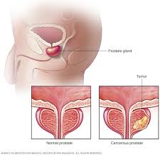 Maybe you would like to learn more about one of these? Hormone Therapy For Prostate Cancer Mayo Clinic