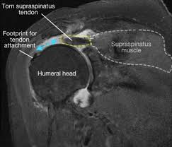 Image result for Rotator Cuff Triad Test