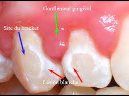 All you need to do is dissolve two teaspoons of salt in a cup of warm water and rinse your mouth, as you would with mouthwash. Home Remedies To Reduce Gum Swelling Youtube