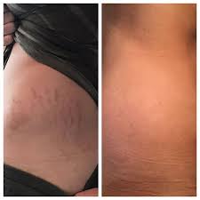 3 Kids No Stretch Marks Grow Baby Grow Organic Etsy Stretch Marks Treating Dry Skin Organic Body Butter