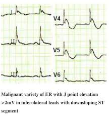 Image result for J Point