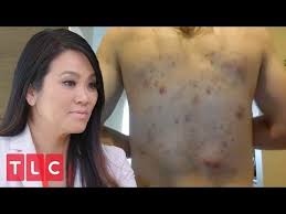 Popping asmr, pimples popping satisfying, pimple popping 2020 pimple popping 2020, pimple popping 2021 new videos. Pin On This And That