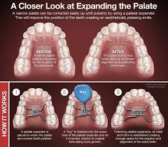 Pin On Dental Health Orthodontics