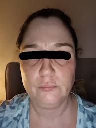 Has anyone had a SMAS neck lift? Here is my before, top left, and now three  weeks out. It's going right back where it was. Doc says skin will tighten  over the