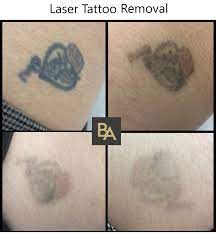 Simply, we like to give our customers what they want, it's our mission. Laser Tattoo Removal Laser Tattoo Laser Tattoo Removal Tattoo Removal