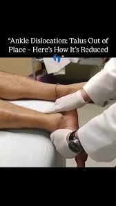 Image result for Ankle Dislocation