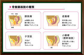 骨盤臓器脱とは（1月24日放送） | 女性のための健康セミナー