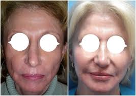 voluma, Cosmetic Dermatology by Wendy Epstein, M.D., F.A.A.D. NYACK, NY  Before and After Gallery