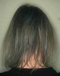 If you do experience side effects, a reduction in dose may minimise these so that you can continue to take the medicine. Drug Reactions Affecting Hair Diagnosis Dermatologic Clinics