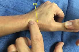 Image result for Elson Extensor Tendon Test
