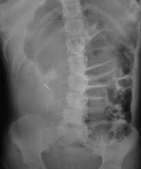 Abdominal Ct-Aided Diagnosis Of Acute Appendicitis In The Presence Of Mobile  Cecum: A Case Report - Sciencedirect