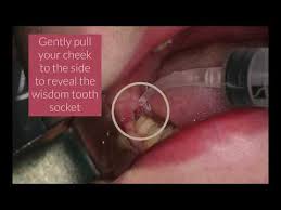 The bleeding from your white stuff in my tooth socket white stuff in my tooth socket do cavities in baby teeth really need vertigo and teeth tooth extraction healing time a socket. Postoperative Care Preoperative Care Innovative Implant Oral Surgery