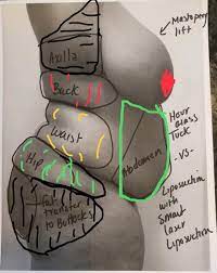 Check spelling or type a new query. How Much Does Brazilian Buttlift Cost In Michigan