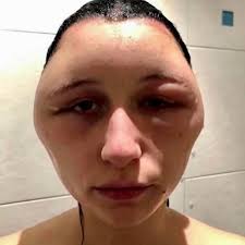 In 2018, a 19-year-old French student named Estelle suffered a severe  allergic reaction after using a home hair dye kit containing  para-phenylenediamine (PPD), a common chemical in many permanent dyes.  Estelle eventually