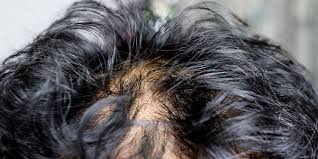 · impacchi o vaporizzazioni di tè sui capelli grassi; Capelli Grassi Da Cosa Sono Causati E Come Rimediare Hasson Wong