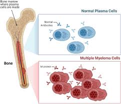 Image result for Multiple Myeloma