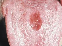 Lues, harter schanker, lues venerea, maselsucht, franzosenkrankheit (maladie française) englisch: Gumma Altmeyers Enzyklopadie Fachbereich Dermatologie