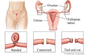 Can a tubal be reversed. Cesarean Section With Tubal Removal Salpingectomy Or Tubal Ligation My Doctor Online
