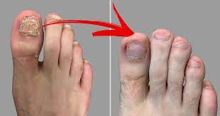 Une mycose est un champignon, et nombreuses sont les variétés de champignons la crème à l'huile d'arbre à thé. 5 Remedes Naturels Pour Soigner La Mycose Des Ongles