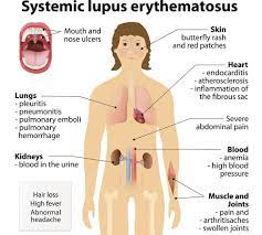 7 Autoimmune Diseases Every Woman Should Know About Essential Oils For Lupus Lupus Symptoms Lupus